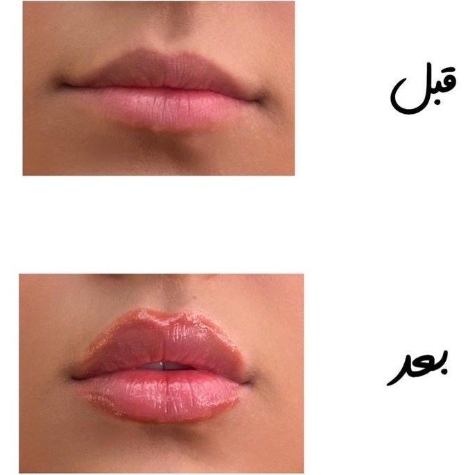 رژلب حجم دهنده لب مدل آمپولی از برند romantic rain با حجم دهندگی و کیفیت عالی با جعبه اصلی در ۶رنگ کاربردی